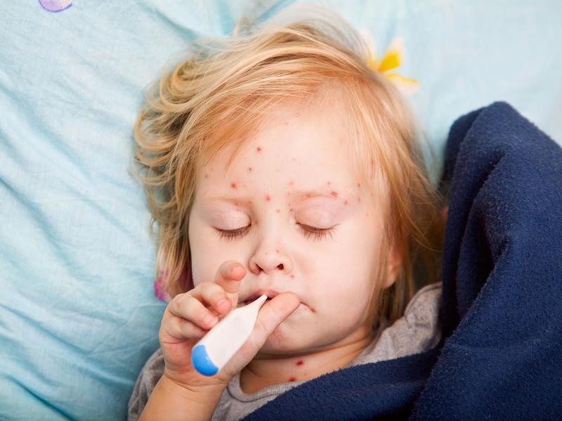 La varicela es una enfermedad común en niños Foto: iStock