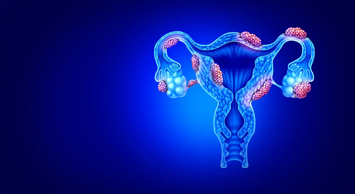 endometriosis ovárica